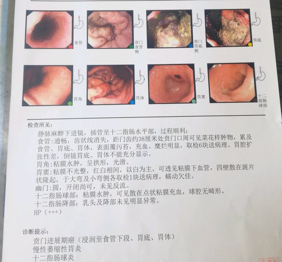 胃癌晚期，不能手术，现在正在化疗。